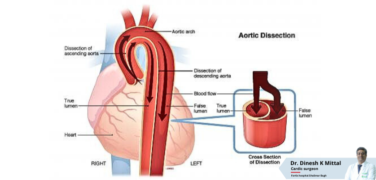 Aortic-Dissection-Treatment-in-Delhi_-Dr.-Dinesh-Kumar-Mittal.png