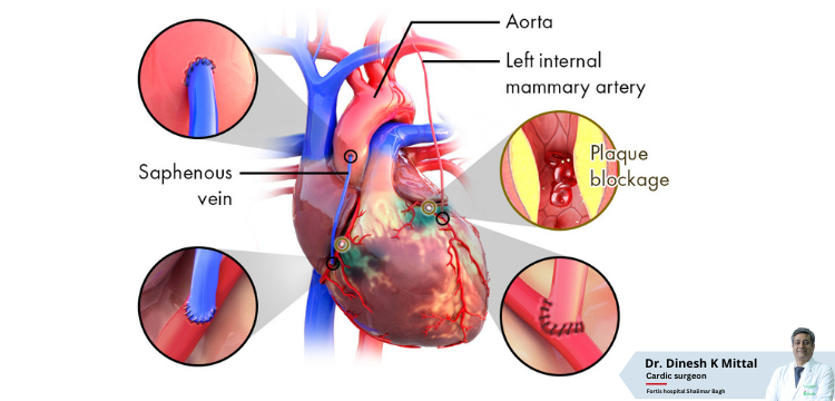 Congenital-Heart-Procedures-Cost-in-Delhi-_-Dr.-Dinesh-Kumar-Mittal.png