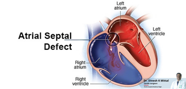 ASD-Closure-Treatment-and-Cost-in-Delhi-NCR-_-Dr.-Dinesh-Kumar-Mittal.png