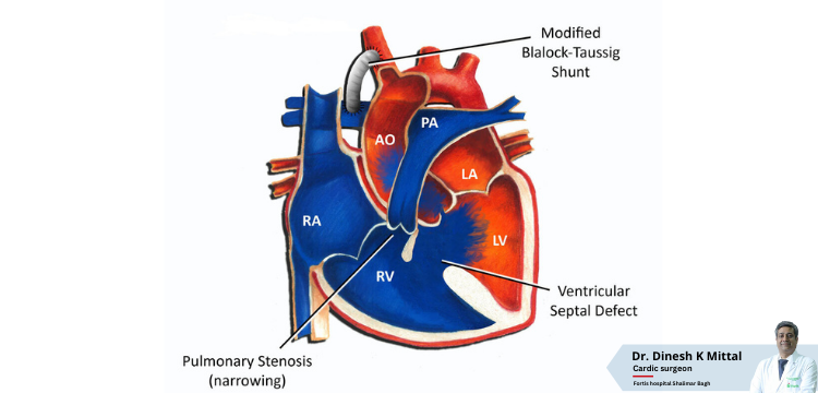 Cost-of-Blalock-Taussig-Shunt-Bt-Shunt-treatment-in-Delhi-_-Dr.-Dinesh-Kumar-Mittal.png