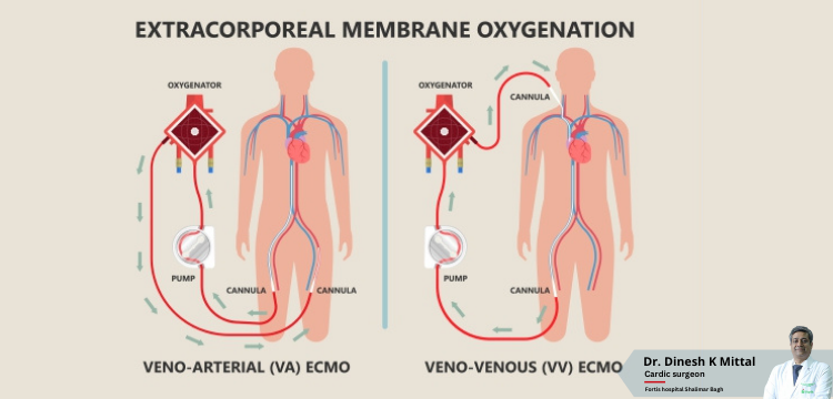 ECMO-Treatment-Cost-in-Delhi-_-Dr.-Dinesh-Kumar-Mittal.png