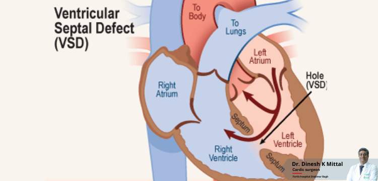 VSD-Closure-Treatment-and-Cost-in-Delhi-NCR-_-Dr.-Dinesh-Kumar-Mittal.png