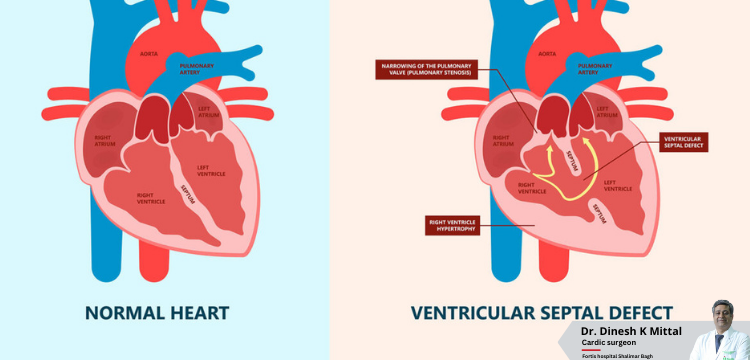 Can-Pediatric-VSD-Closure-Prevent-Future-Heart-Complications.png