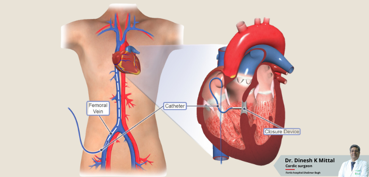 Is-Adult-VSD-Closure-a-Viable-Solution-for-Heart-Problems.png