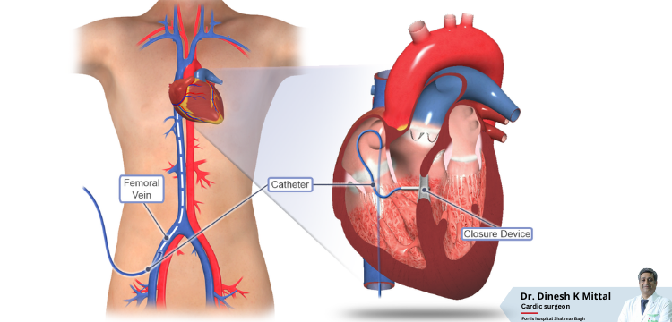 What-Are-the-Various-Treatment-Options-Available-for-VSD.png