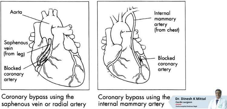 What-is-the-Difference-Between-On-Pump-and-Off-Pump-CABG.png