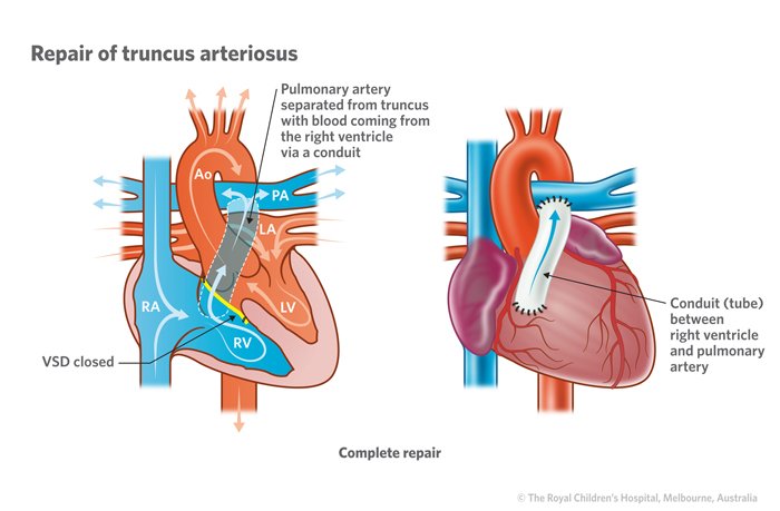 20b_Truncus_arteriosus.jpg