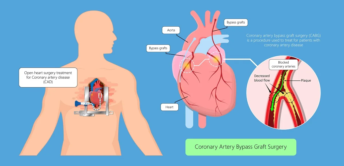 Coronary-Artery-Bypass-Graft.webp