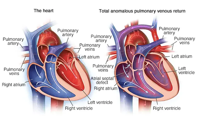 mcdc7_total-anomalous-pulmonary-venous-return-8col-2-e1711091324922.webp