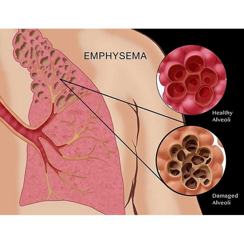 emphysema-mateis-salt-cave-1.jpg