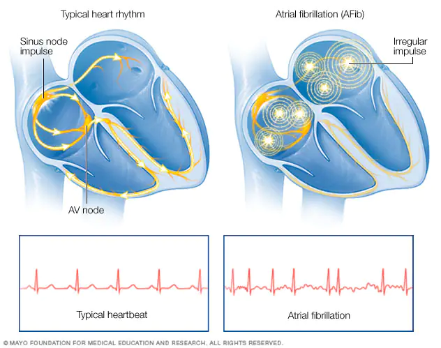 mcdc11_heartforafib.webp