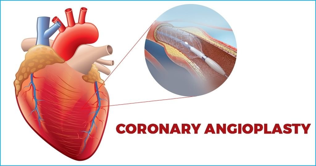 Coronary-Angioplasty-intro-image.jpg