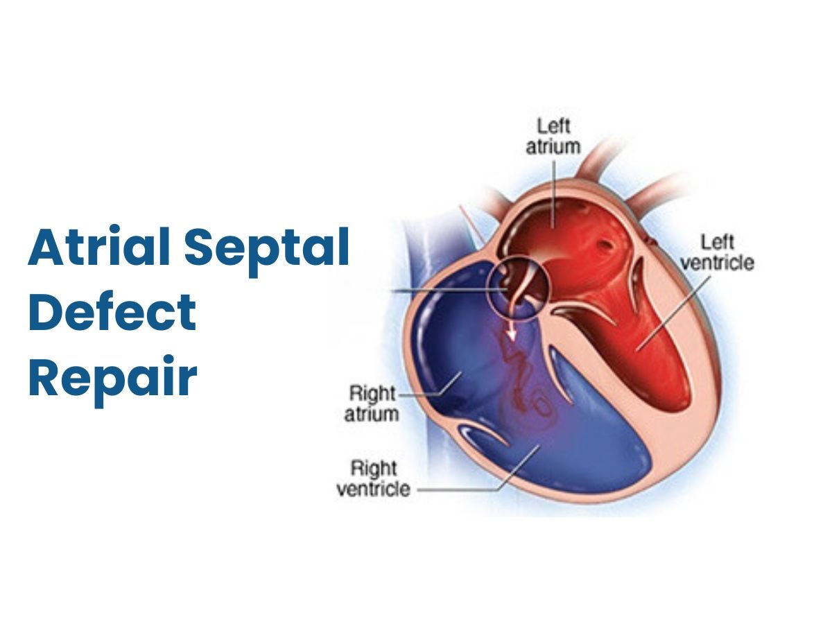 Atrial-Septal-Defect-Repair.jpg