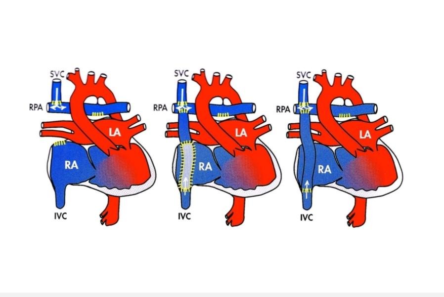 What You Need to Know About the Fontan Procedure?