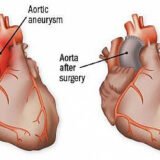 When is an Aneurysm Repair Surgery Needed?