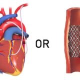 When Is Stent Placement Better Than Open Surgery