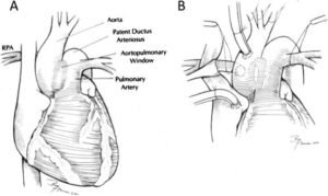 What Are the Risk Factors Associated with Aortopulmonary Window?