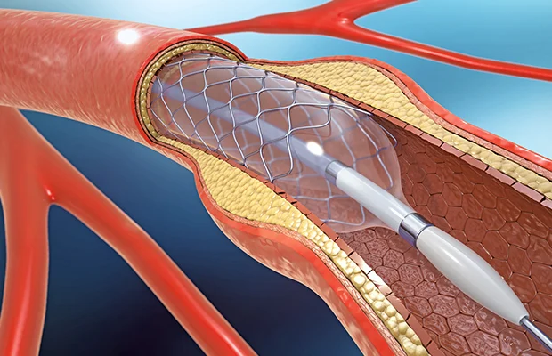 What is Angioplasty? Understanding its Types, Procedures, Risks, and Recovery