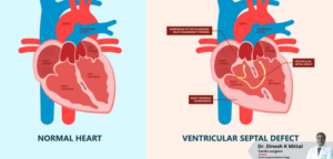 Can Pediatric VSD Closure Prevent Future Heart Complications? – Dr. Dinesh Mittal