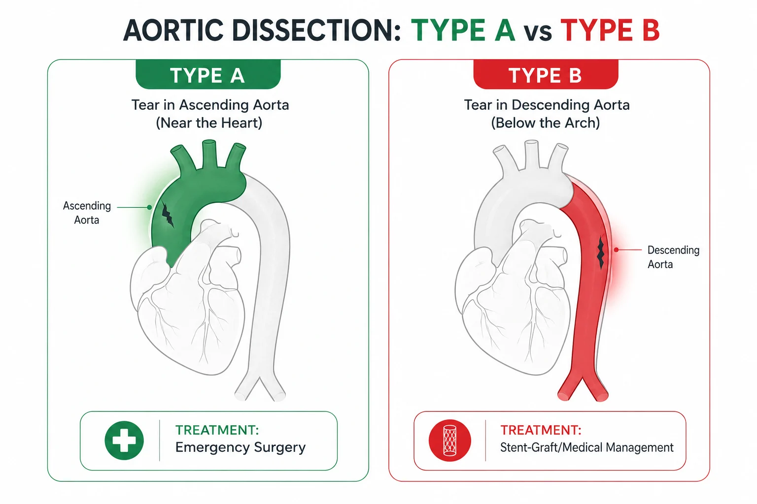 Diagram comparing Type A and Type B aortic dissection and their treatment. Aortic Dissection Treatment in Delhi