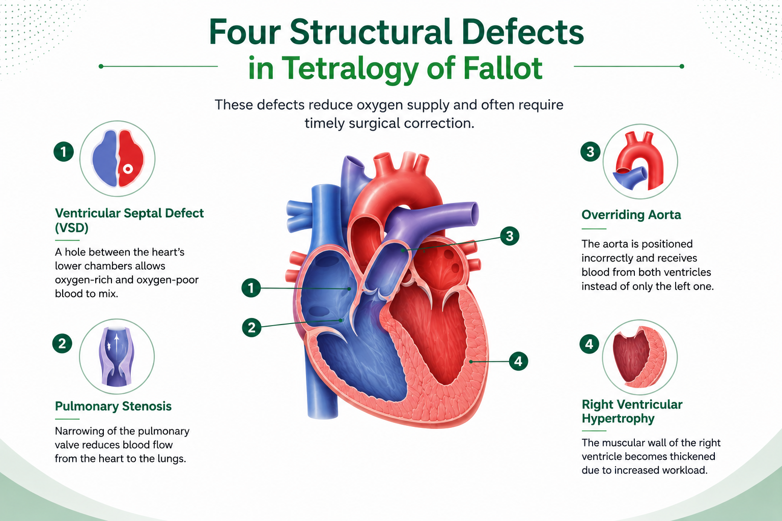 Tetralogy of Fallot: Four Structural Defects in Tetralogy of Fallot