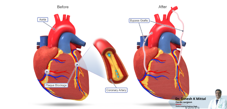 How is Total Arterial CABG Beneficial for Cardiac Wellness and Longevity of a Patient’s Life? – Dr. Dinesh Mittal