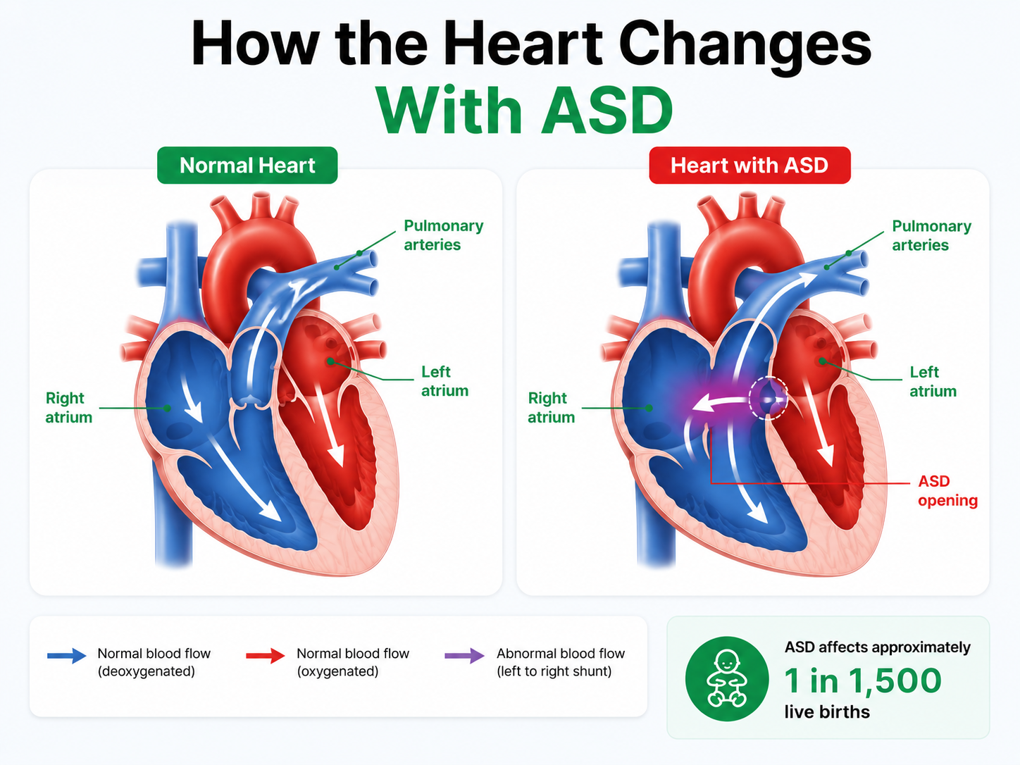 Atrial Septal Defect