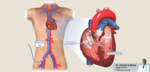 Is Adult VSD Closure a Viable Solution for Heart Problems? – Dr. Dinesh Mittal