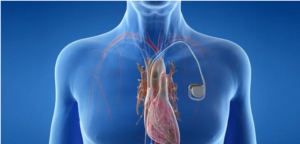 Pacemaker Surgery Cost In Delhi | Dr. Dinesh Kumar Mittal – Dr. Dinesh Mittal
