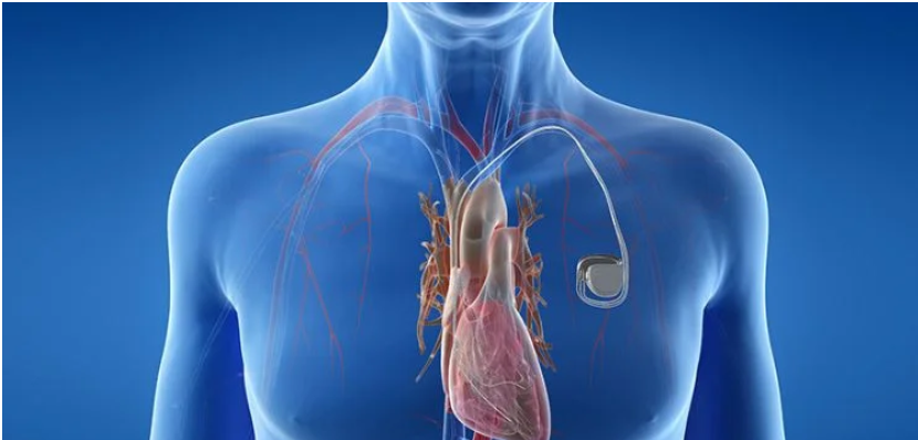 Pacemaker Surgery Cost In Delhi | Dr. Dinesh Kumar Mittal – Dr. Dinesh Mittal