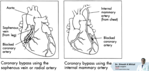 What is the Difference Between On-Pump and Off-Pump CABG? – Dr. Dinesh Mittal