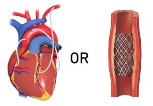 When Is Stent Placement Better Than Open Surgery? – Dr. Dinesh Mittal