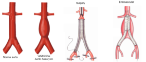 How Does Aortic Intervention Help Treat Aortic Aneurysms? – Dr. Dinesh Mittal