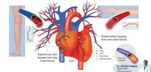 Congenital Heart Procedures Cost in Delhi | Dr. Dinesh Kumar Mittal – Dr. Dinesh Mittal