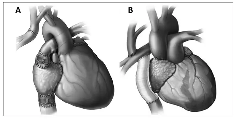 Is Fontan Surgery the Right Choice for My Child’s Heart Condition?