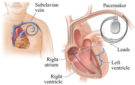 Can Biventricular Pacemaker Implantation Improve Heart Function ...