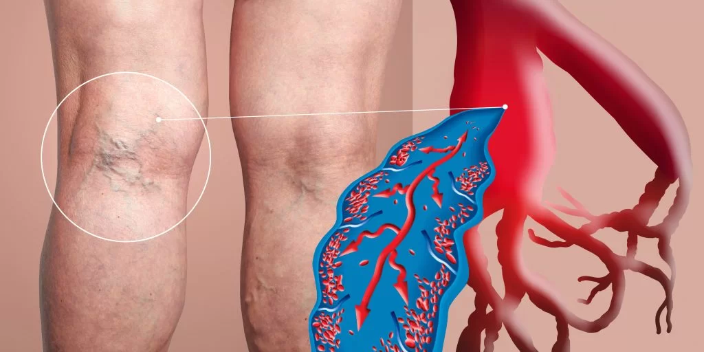 Can Varicose Veins Lead to Heart Problems?