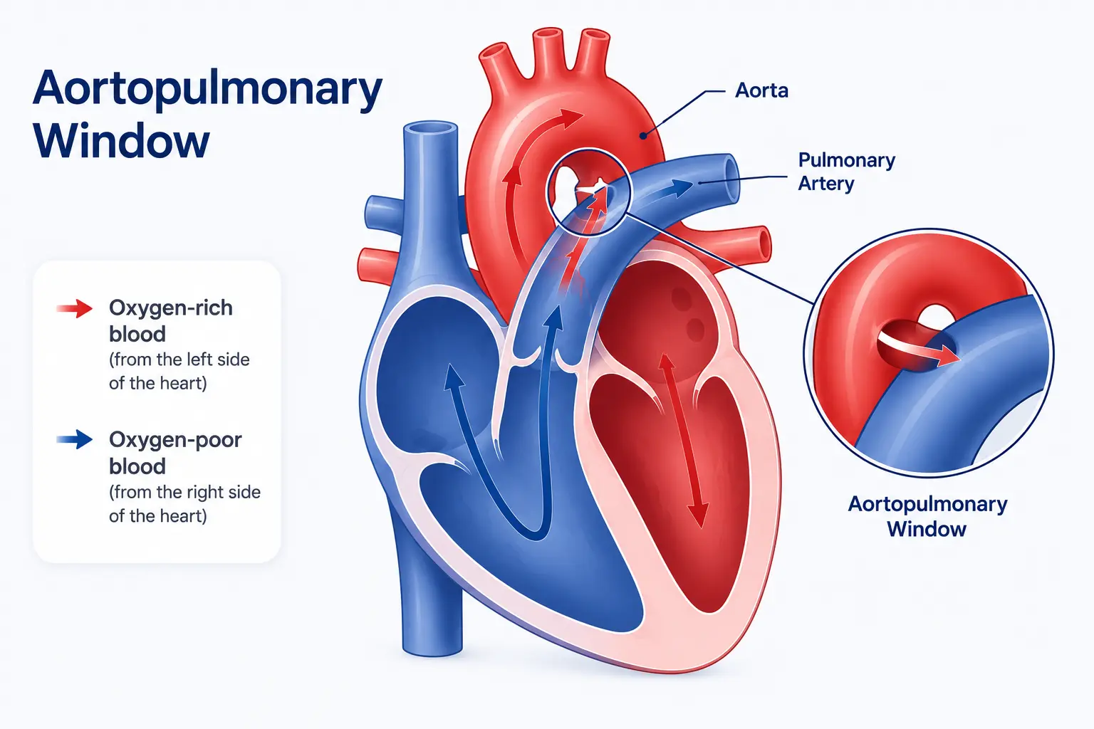Aortopulmonary Window (AP Window) Treatment in Delhi