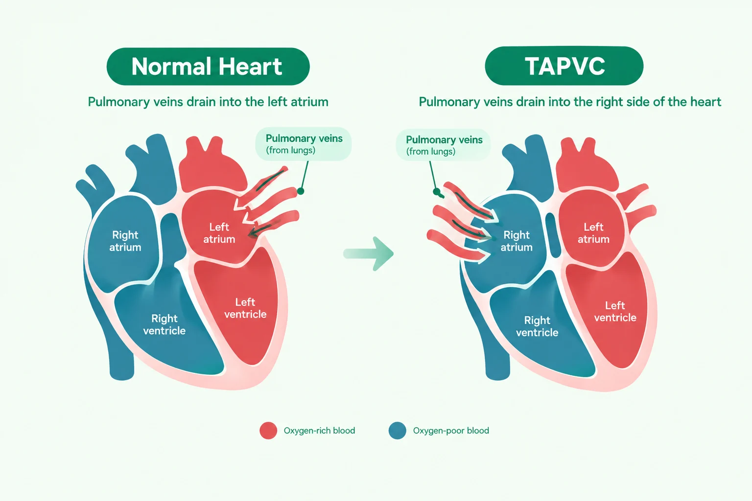Illustration comparing normal pulmonary vein blood flow with Total Anomalous Pulmonary Venous Connection (TAPVC) in the heart