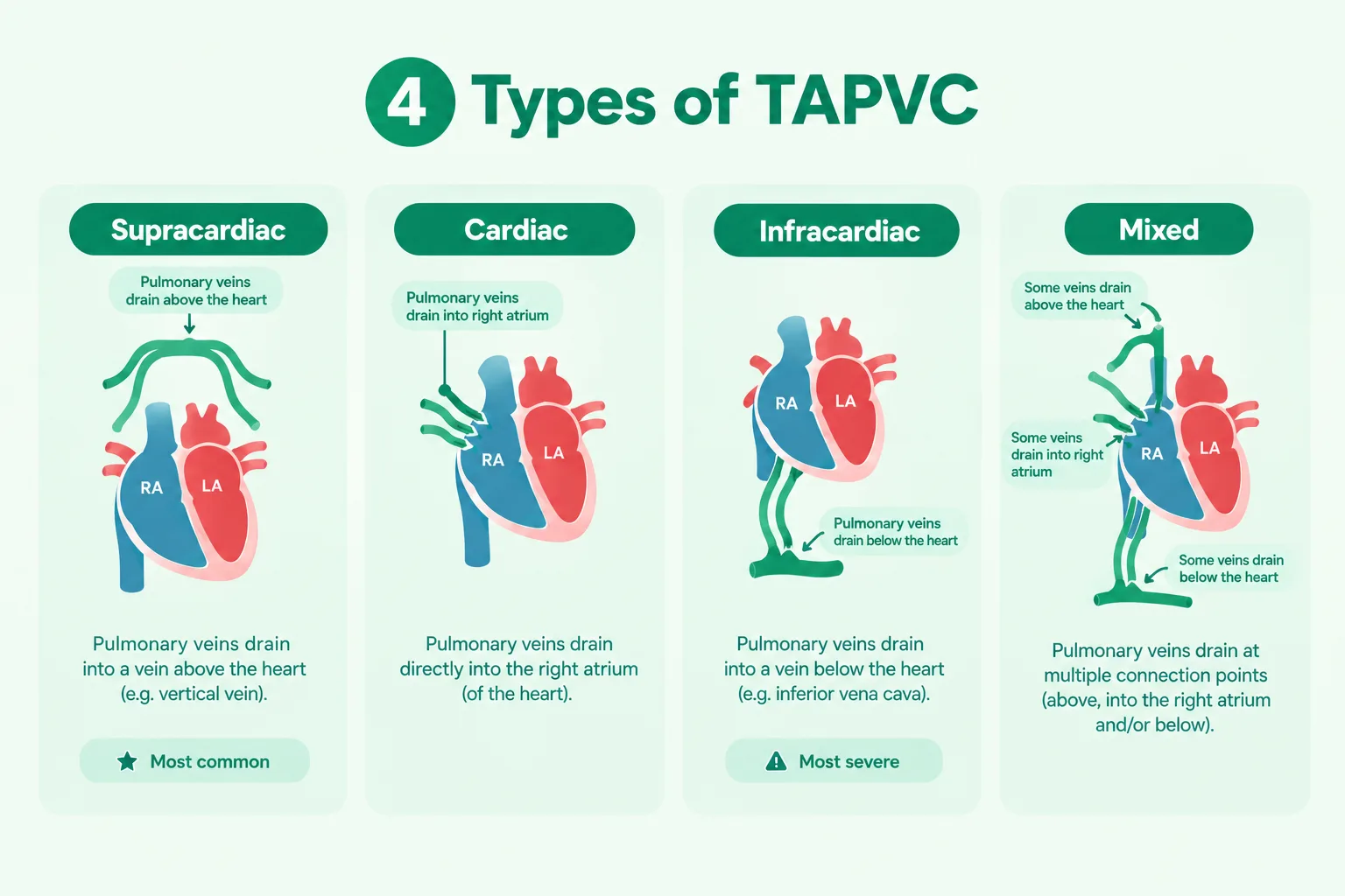 Infographic showing the four types of TAPVC: supracardiac, cardiac, infracardiac, and mixed