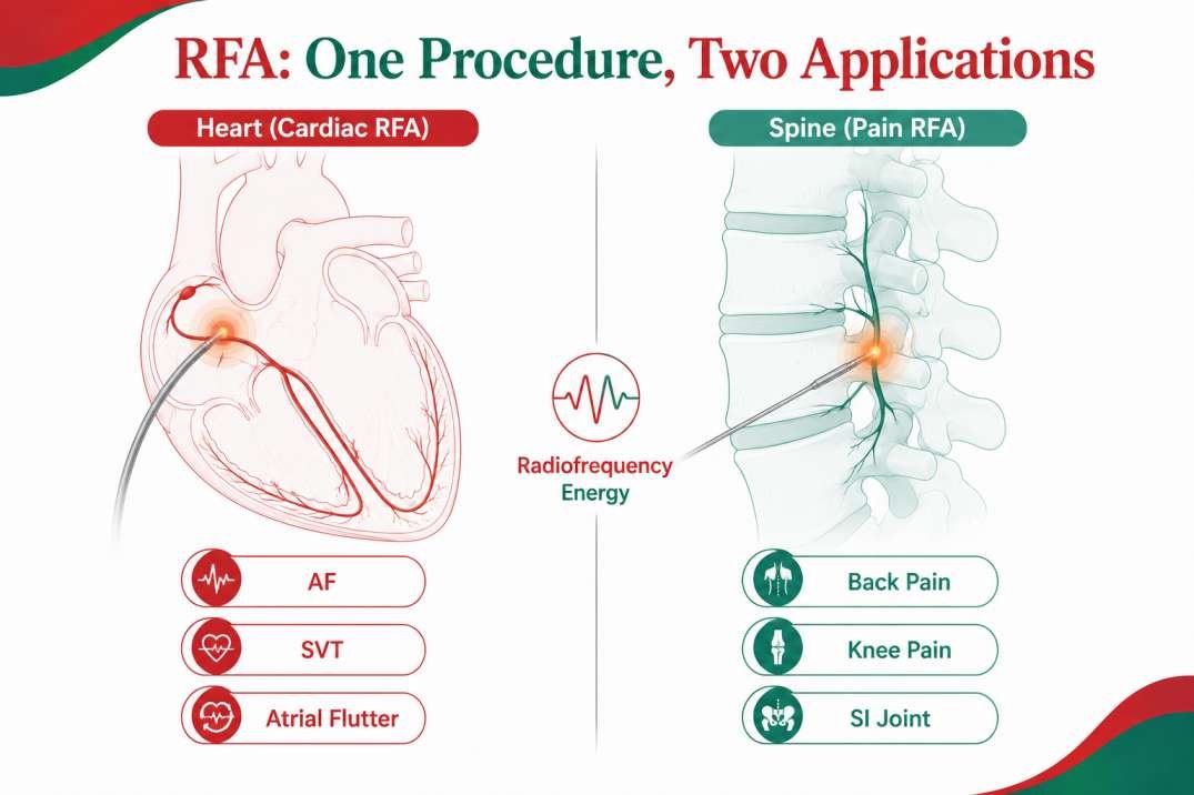 Radiofrequency Ablation in Delhi application