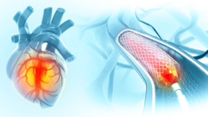 CABG vs. Angioplasty: How Do You Know Which One You Actually Need?