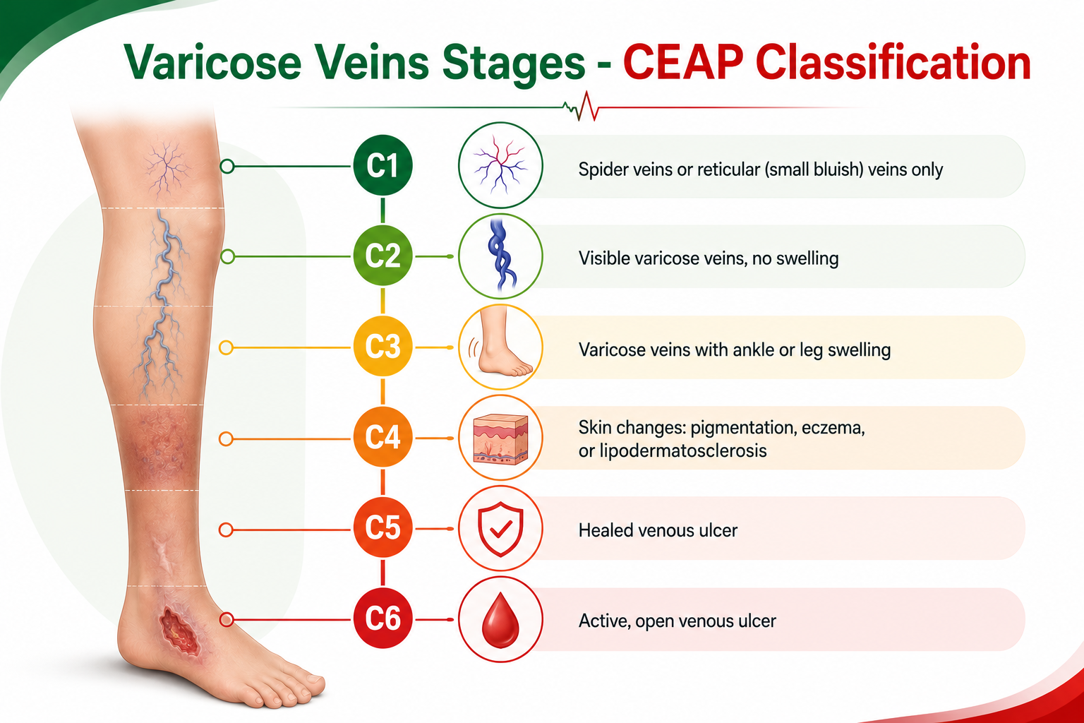Varicose Veins Stages -CEAP Classification