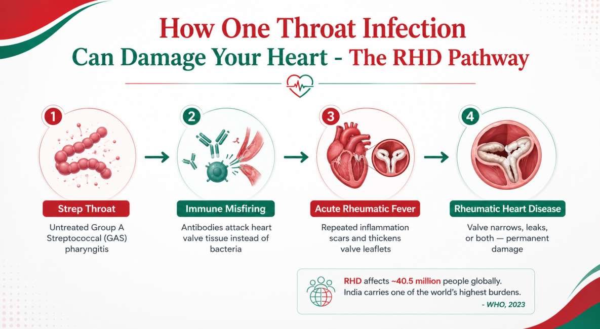 How Does Rheumatic Heart Disease Develop?