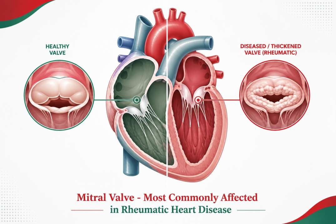 Rheumatic Heart Disease Treatment in Delhi