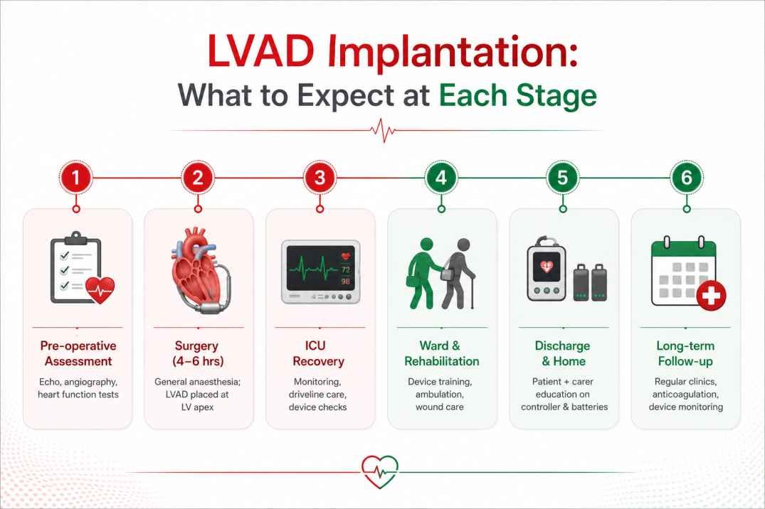 Infographic showing the 6 stages of LVAD implantation from pre-operative assessment to long-term follow-up – Dr. Dinesh Kumar Mittal, Delhi