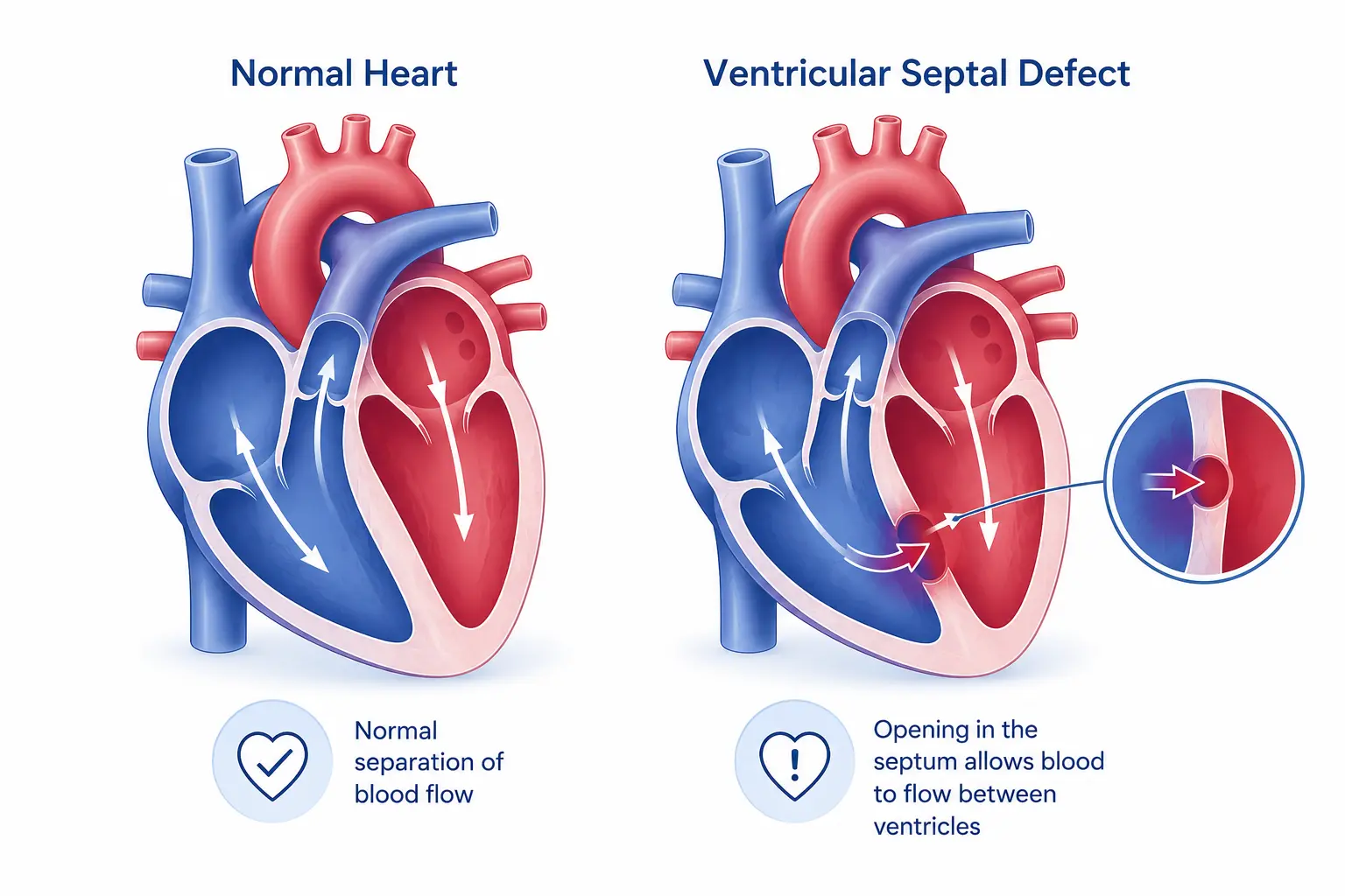 Ventricular Septal Defect Surgery in Delhi