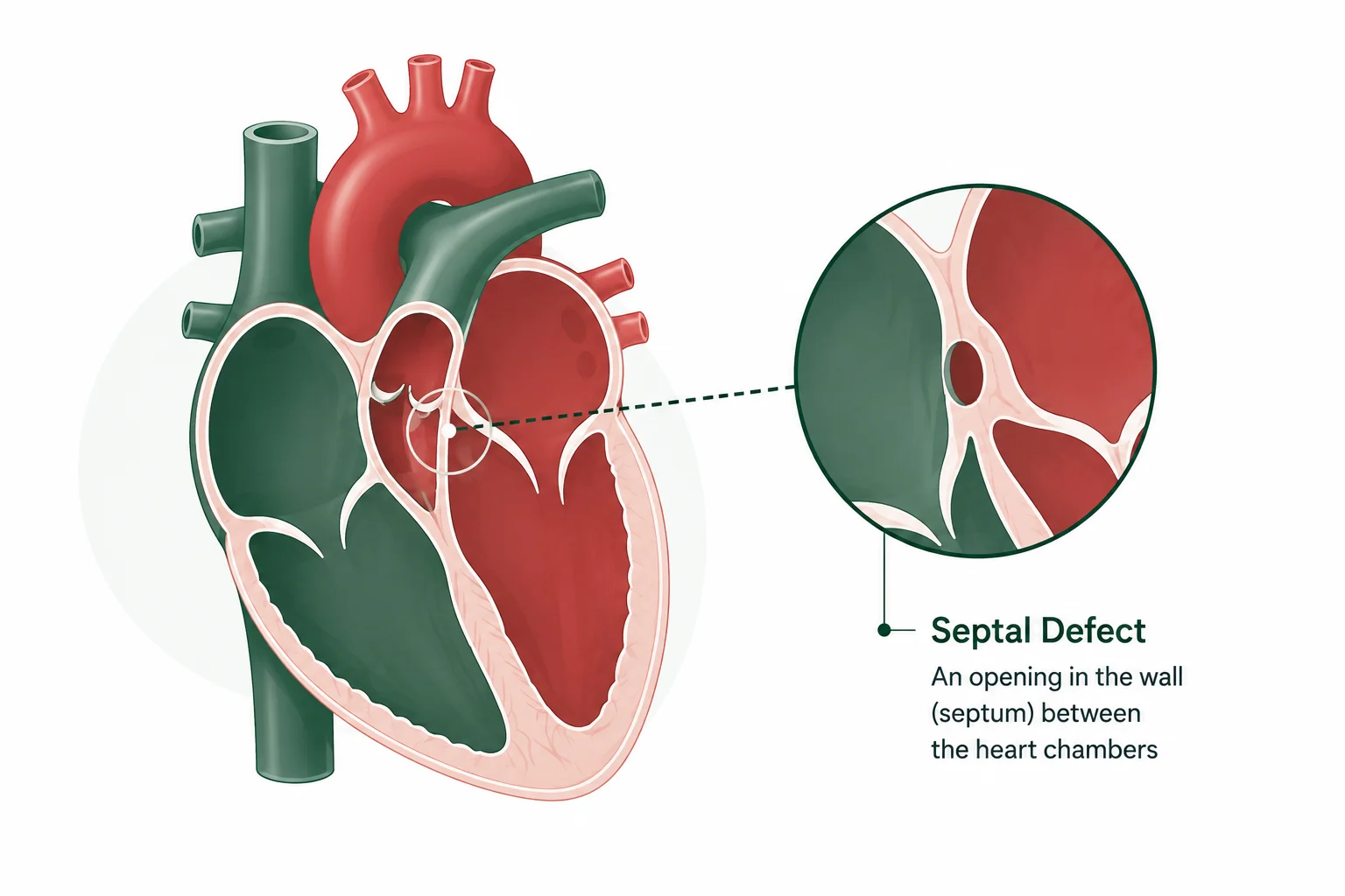 Congenital Heart Surgery Cost in India. Dr.  Dinesh Kumar Mittal. Best CTVS surgeon Delhi.
