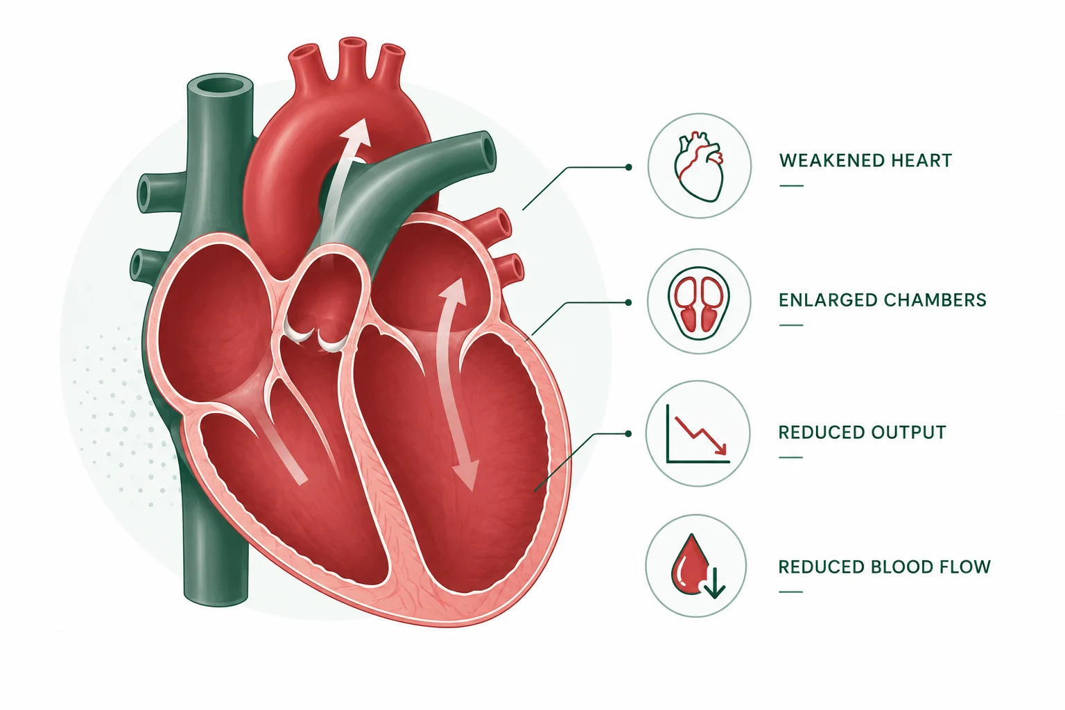 Illustration of a weakened heart with reduced pumping capacity in heart failure. Heart Failure treatment in Delhi.