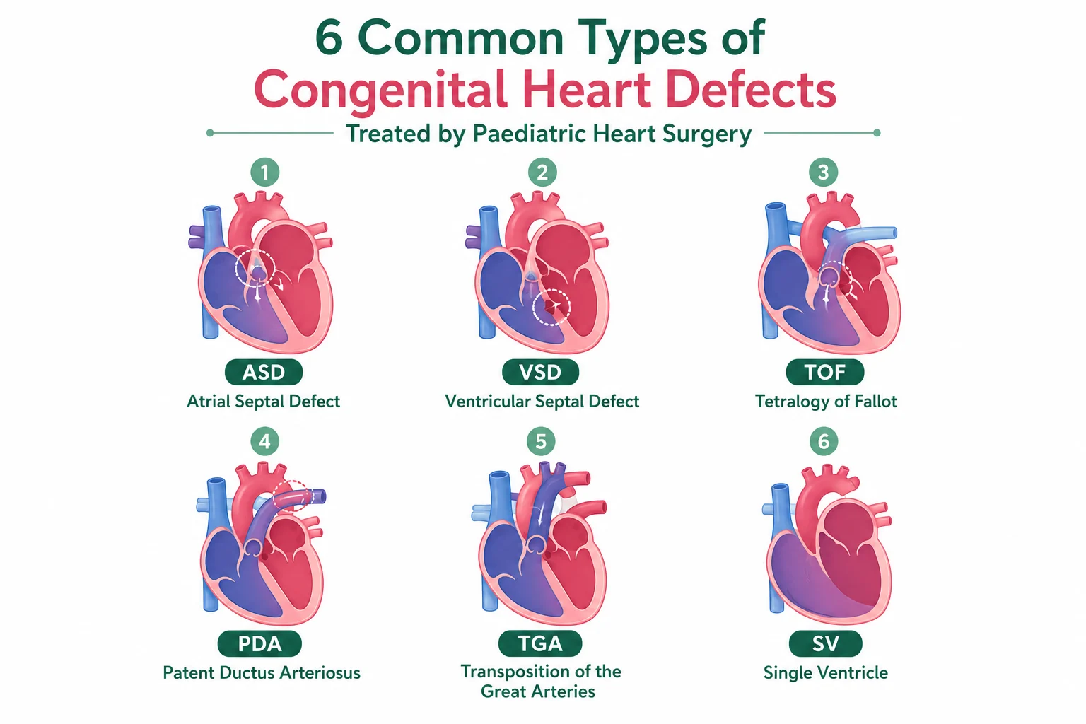 Types of Congenital heart defects in Children.